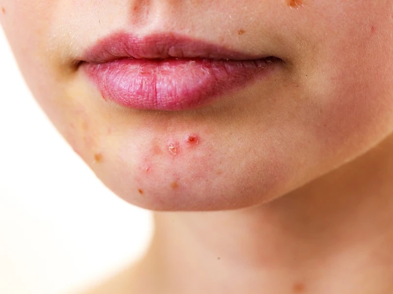 How Effective is Holistic Acne Medication?