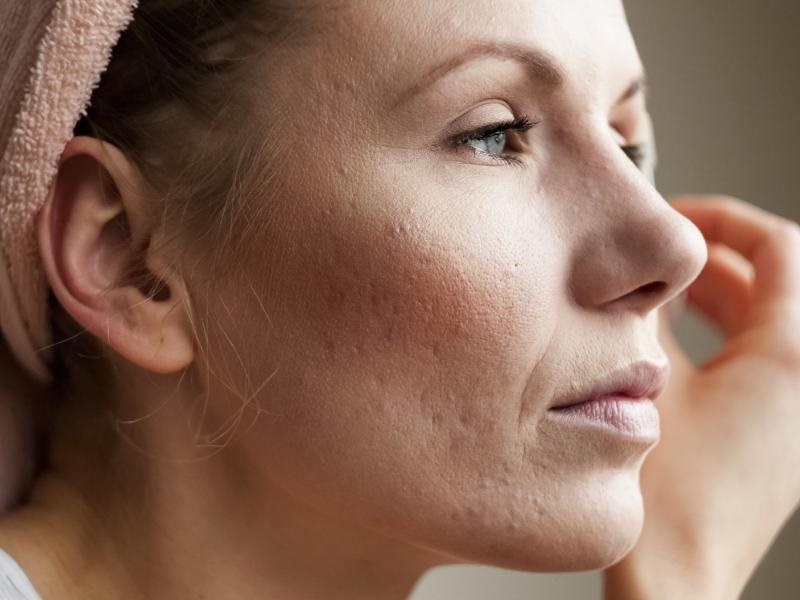 Is Teenage Acne Really Stimulated by Bread?