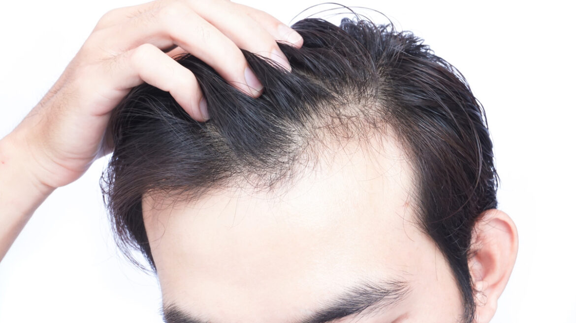 The Best Ways To Fix Your Hair Loss