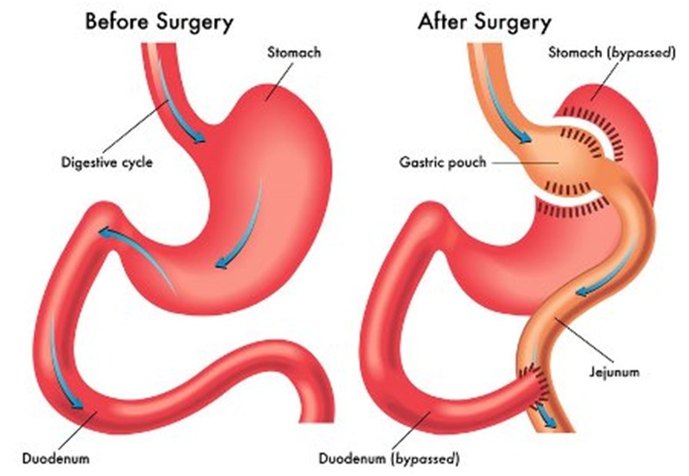 Which pain medicine is prescribed to a patient coming from a gastric sleeve?