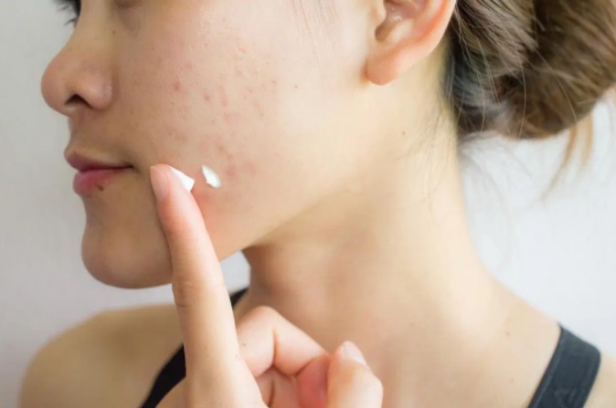 Methods Of Acne Scar Treatment That Suits Your Skin