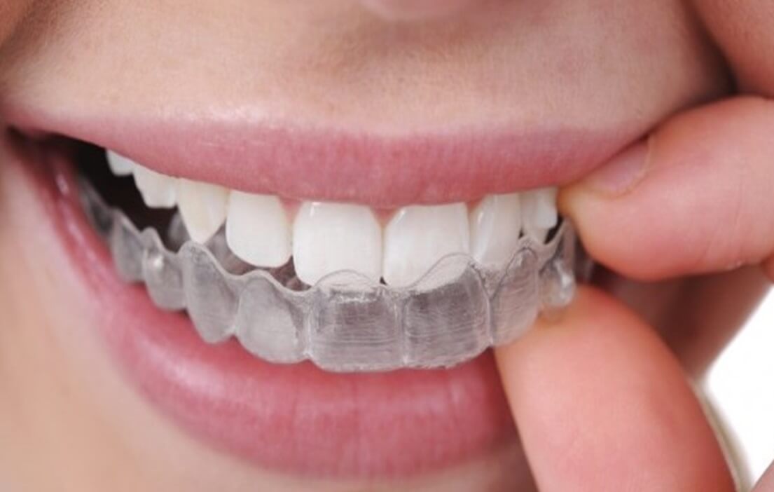 Only Invisalign Dentist Ottawa Can Bring Your Million Dollar Smile