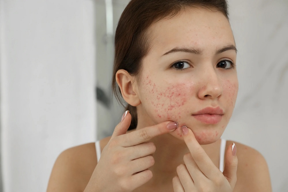 What Are Acne Scars? – Some Facts Revealed