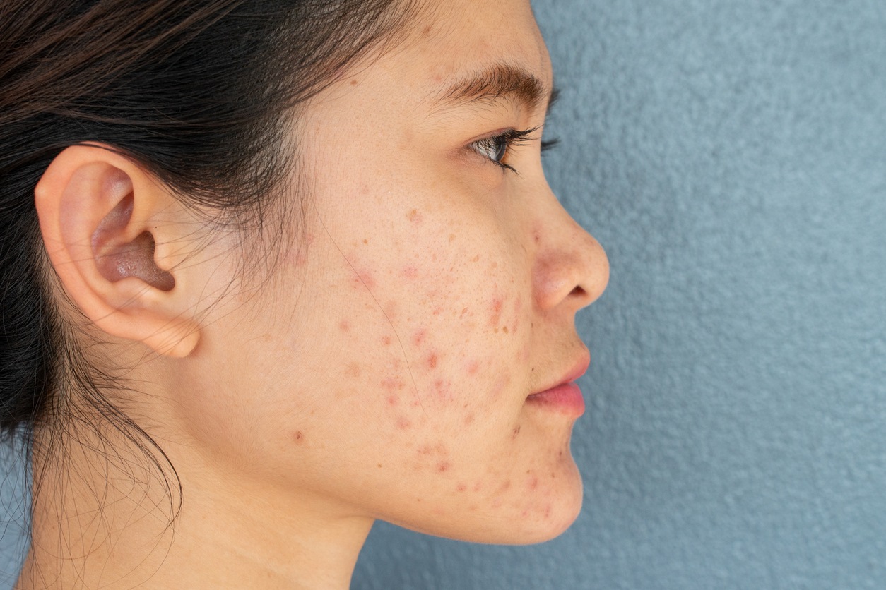 Various Laser Treatments for Acne Scars - Original Fitness CO