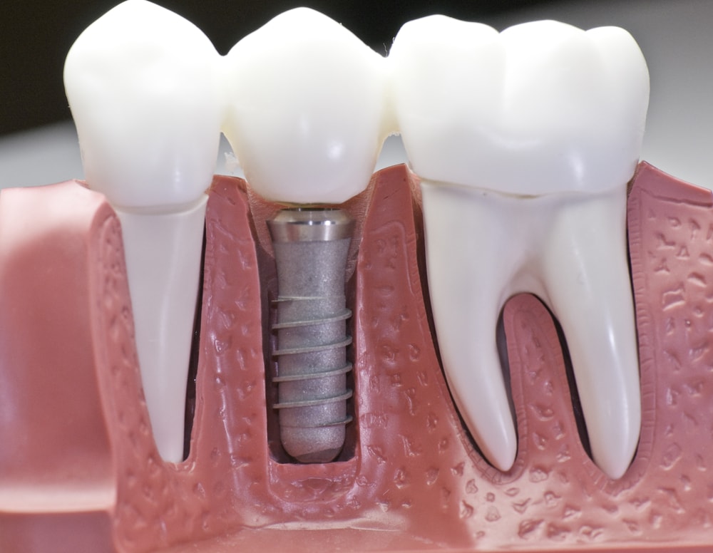 How to Prepare for Dental Implants Effectively