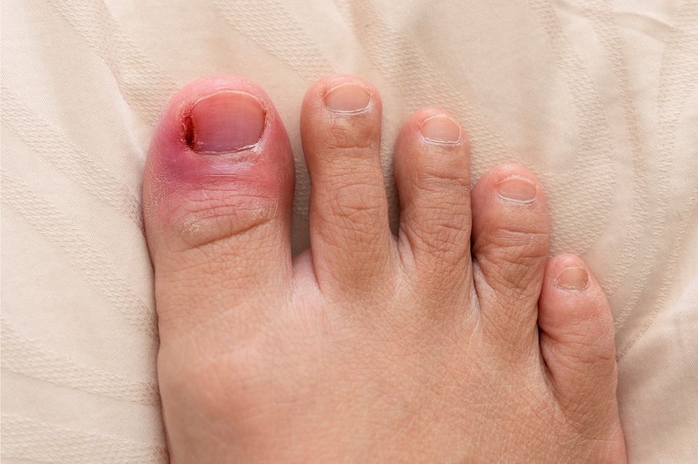 Onychocryptosis: How To Treat Ingrown Toenail Condition?