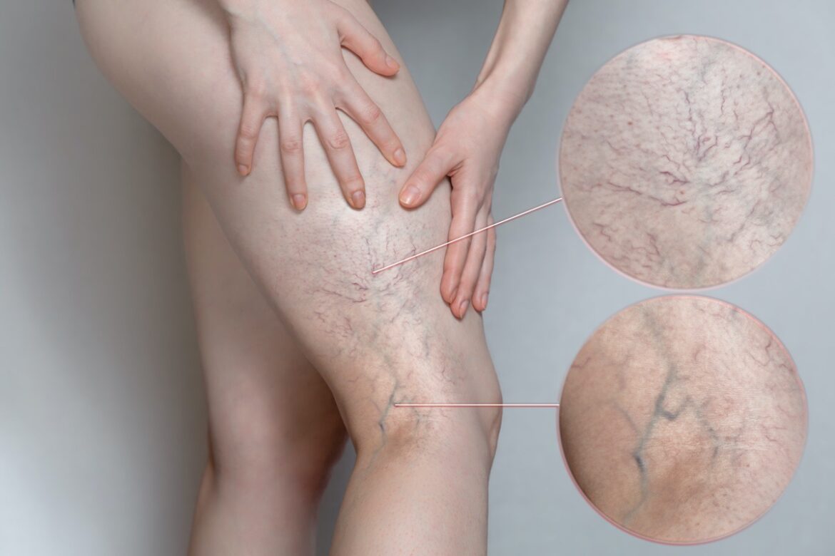 Minimally Invasive Treatments for Varicose Veins