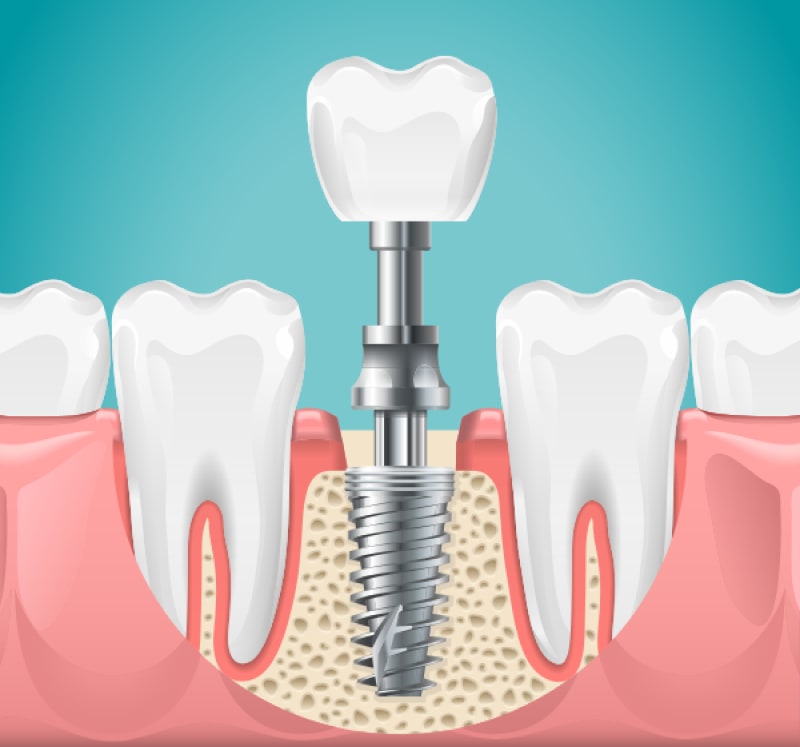The Procedure of All-on-4 Dental Implants
