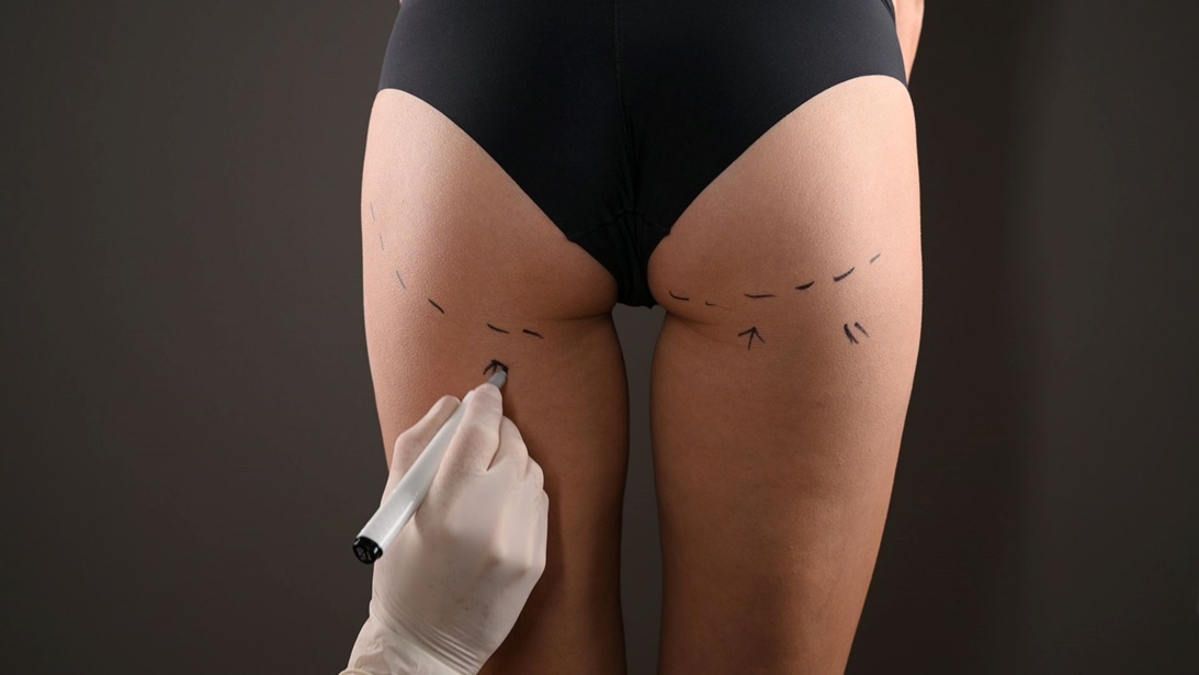 Is Brazilian Buttock Lift Permanent?