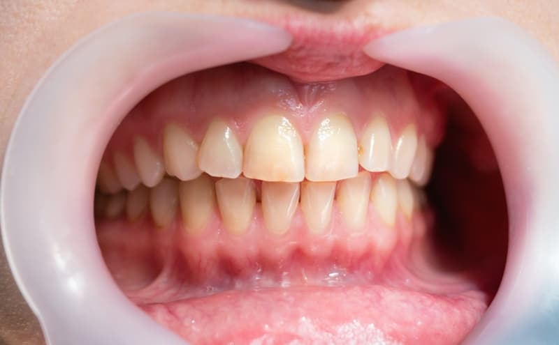 Indicative Signs You Suffer From Periodontal Disease