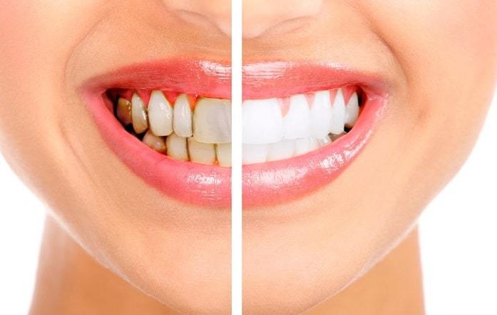 Teeth Whitening: What Is It and Why It is Important