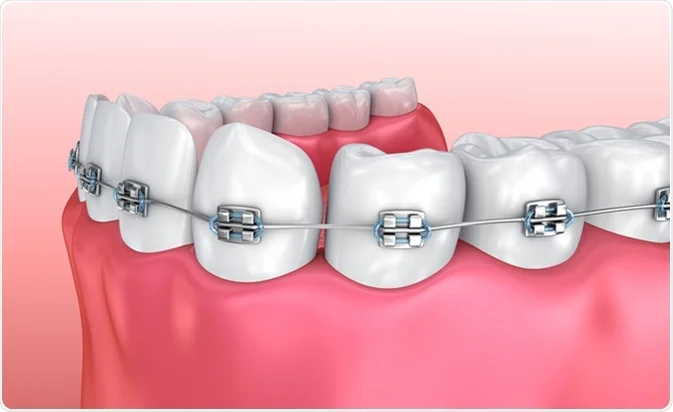 Top 6 Benefits of Using Dental Braces