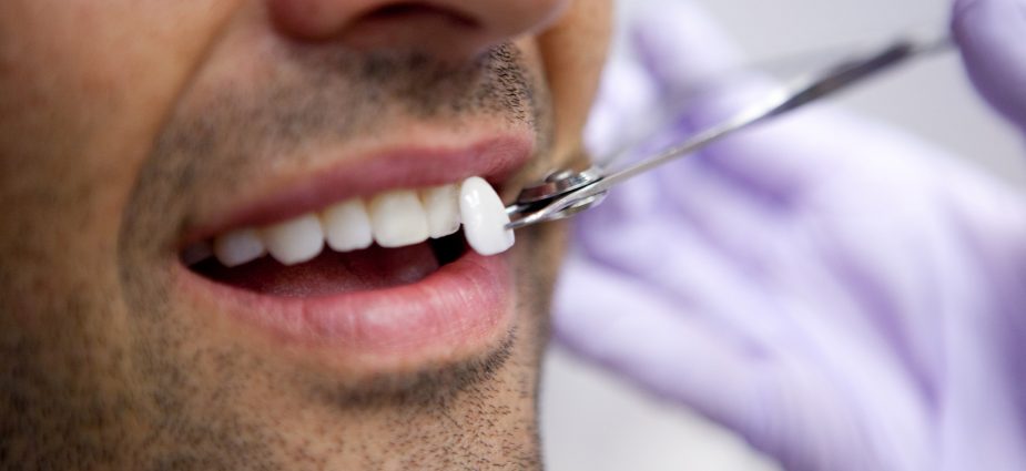 Little-Known Facts Concerning the Dental Veneers