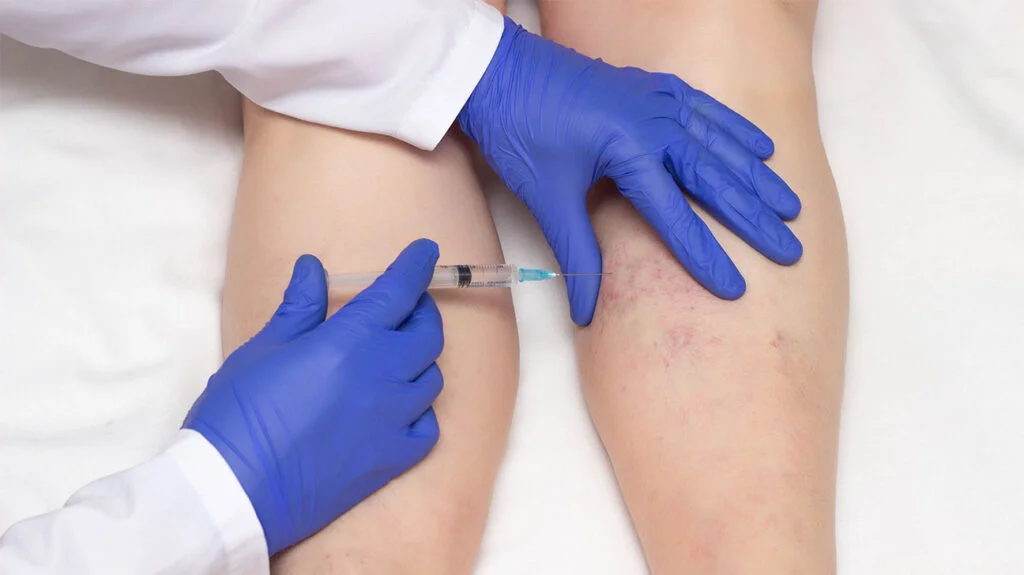Sclerotherapy Treatment– Aftercare Advice 