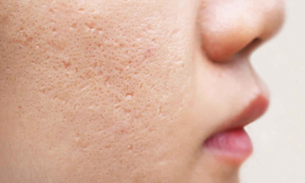 No More Pimple Marks: Checkout These Essential Steps For Clearing Your Skin