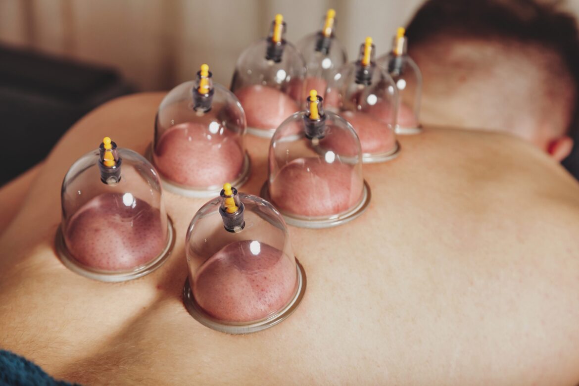 Cupping Therapy: Unveiling the Ancient Art of Healing