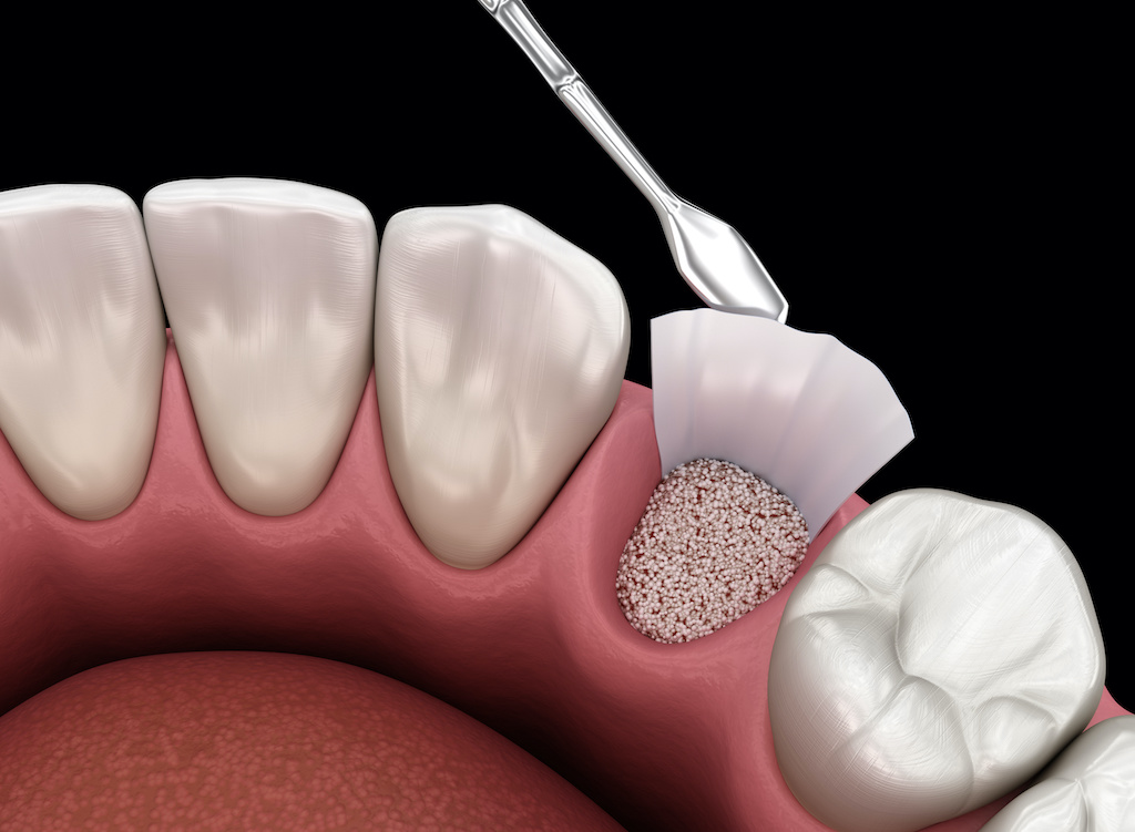 The Power of Bone Grafting in Revival of Your Oral Health