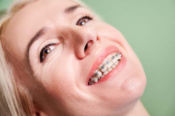 The Benefits of Orthodontic Treatment for Adults