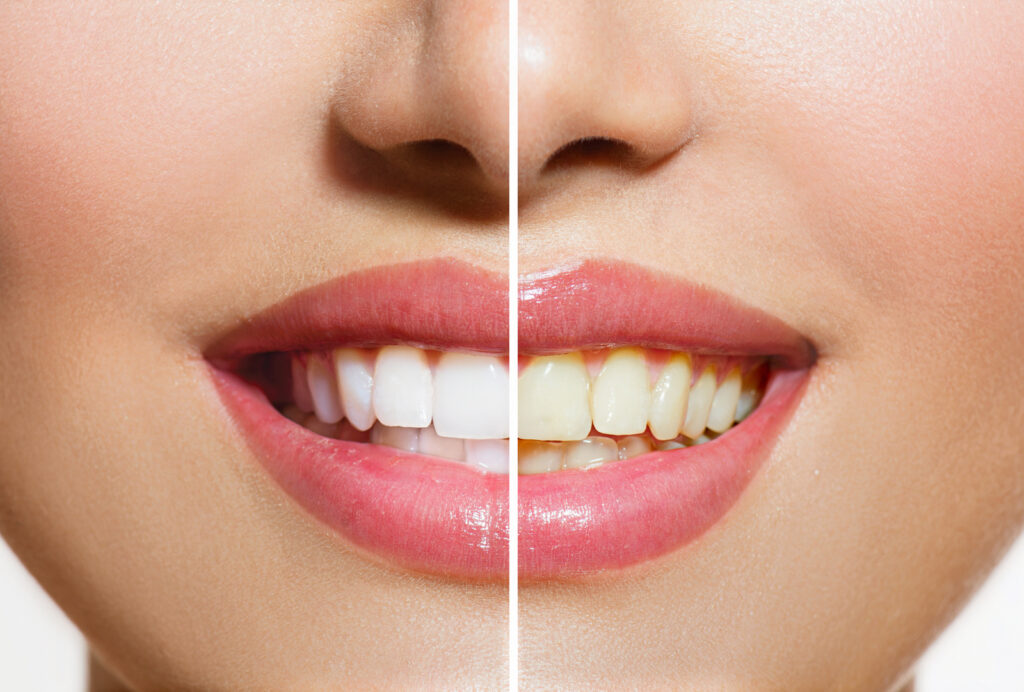 Whitening Options: Professional vs At-Home