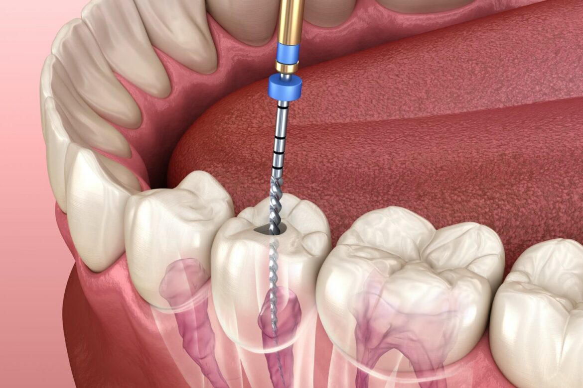 Keeping Your Smile Intact: Preventing the Need for Root Canal Treatment in Grand Rapids