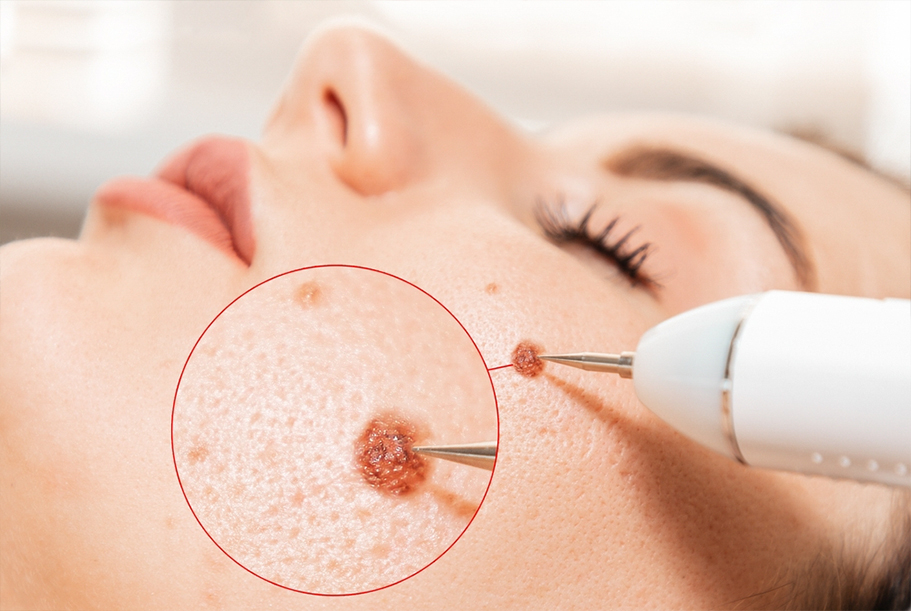 Easy Guide to Wart Removal: CO2 and Laser Treatments