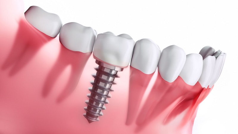 The Ultimate Confidence Booster: Real Stories of Lives Changed by Full Arch Dental Implants