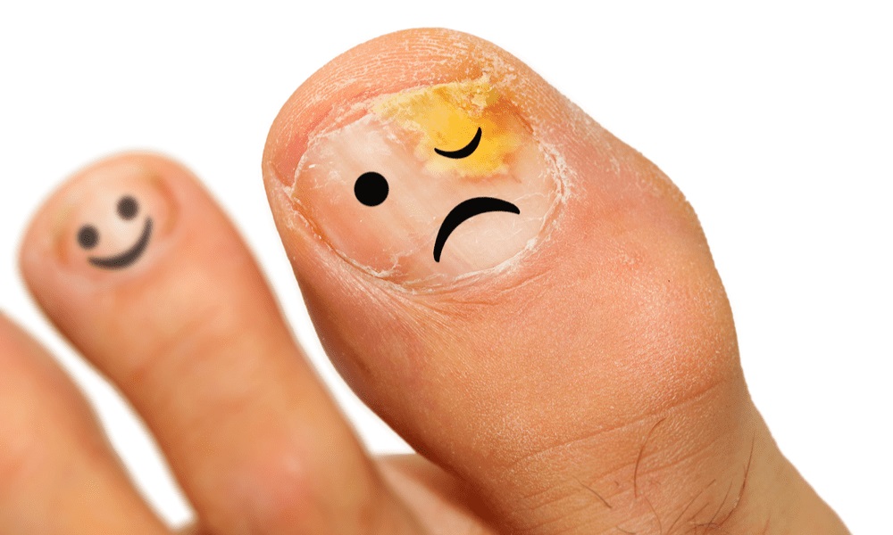 Okita Nail Fungus Light Reviews: How Effective Is This At-Home Solution?