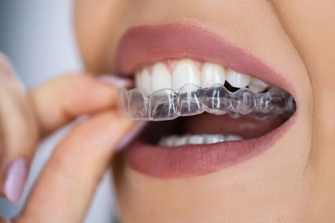 Why Clear Aligners Are the Best Choice for Busy Professionals