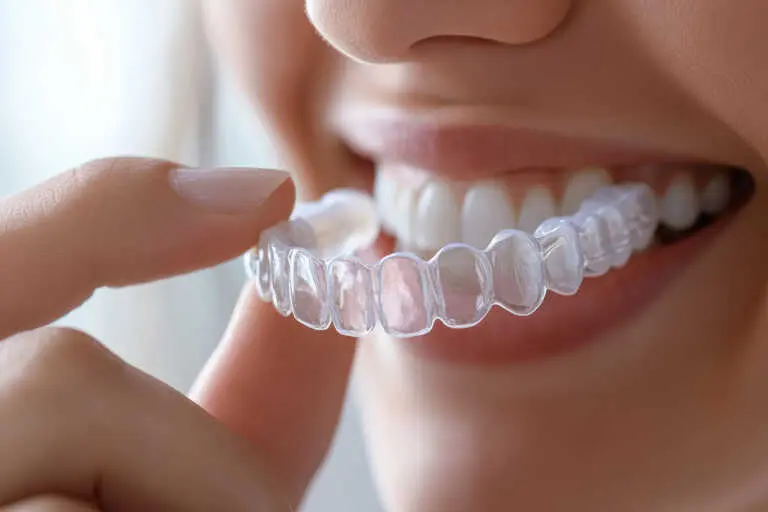 How Clear Aligners Move Teeth Without Metal Wires