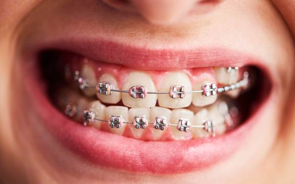 Braces in Singapore: What to Expect from Your First Consultation to Final Results