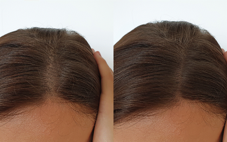 Regrow Hair Naturally with Treatments in Singapore