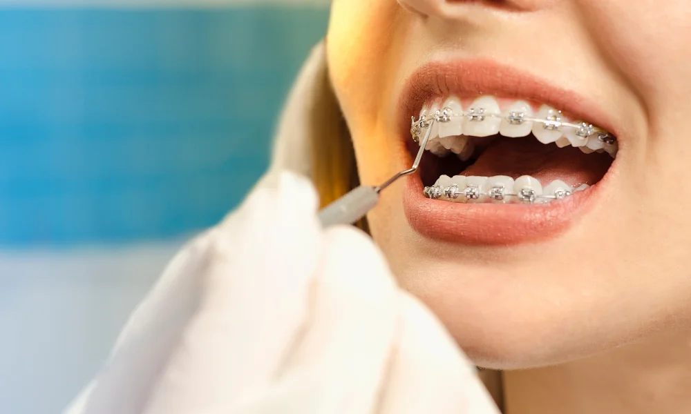 How Much Do Braces Cost?